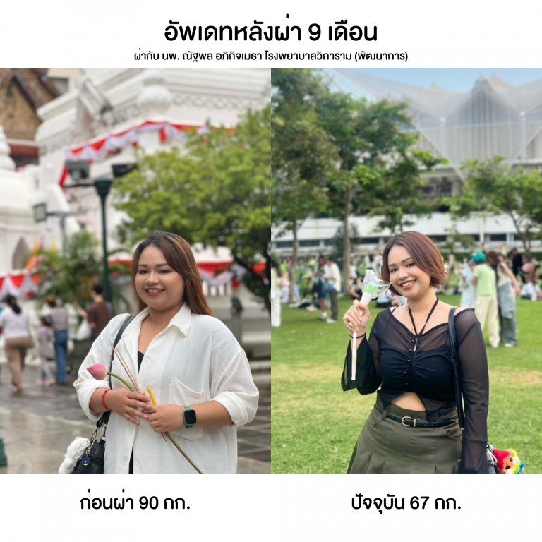 รีวิวผ่ากระเพาะ (1)